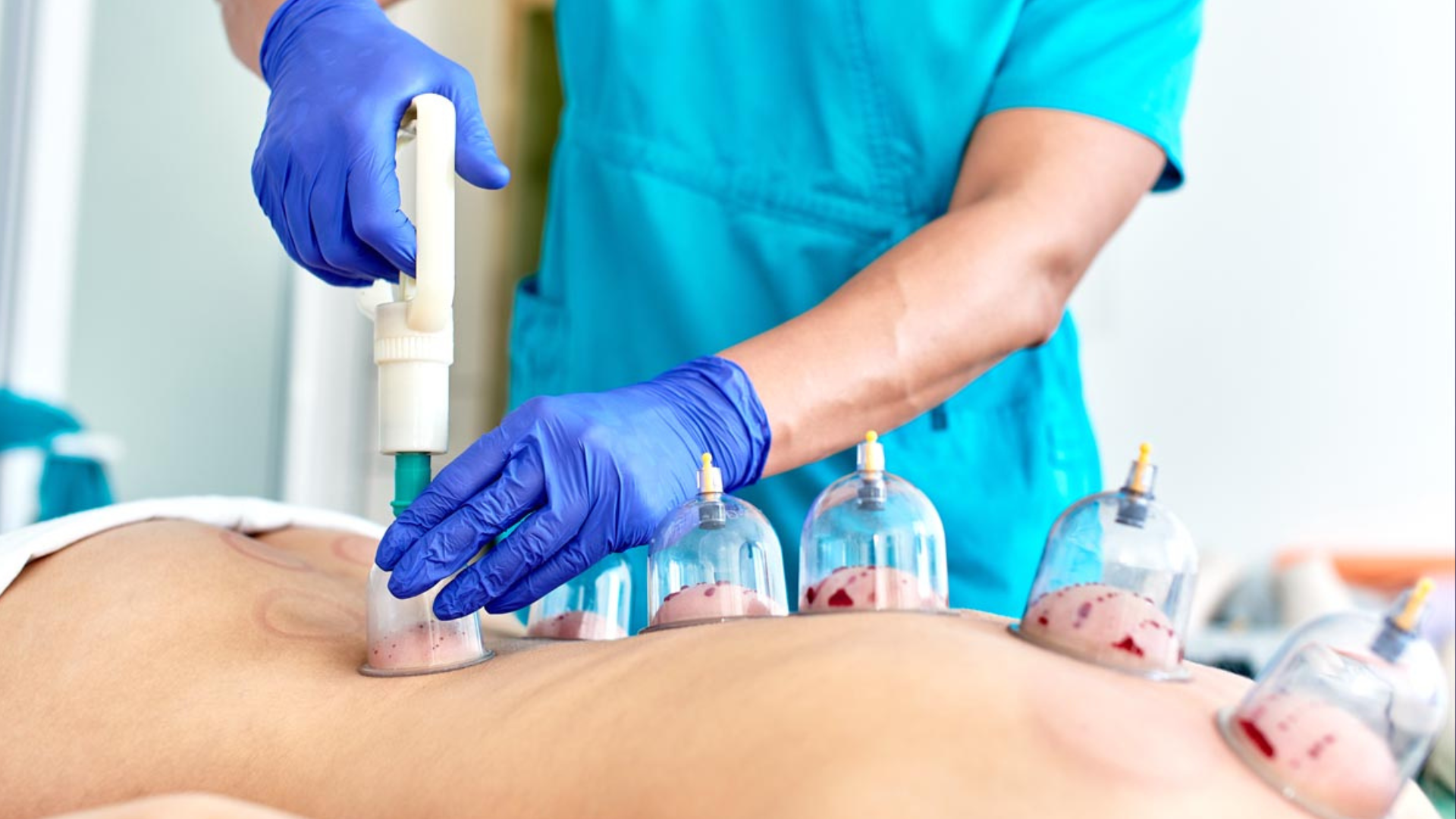 Why is Hijama Becoming a Trend? Discover the Incredible Benefits of Cupping Therapy!